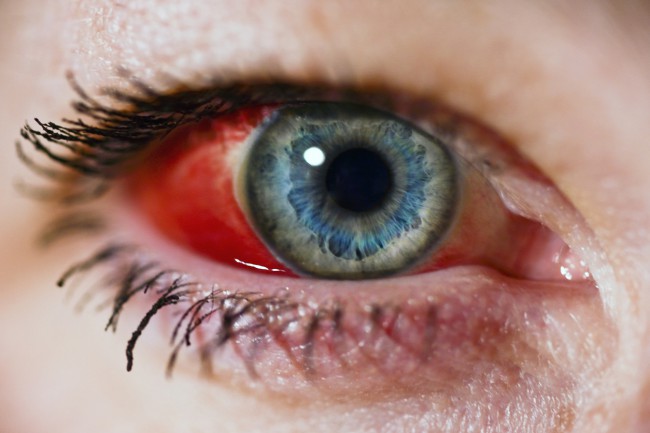 hemoragie oculara