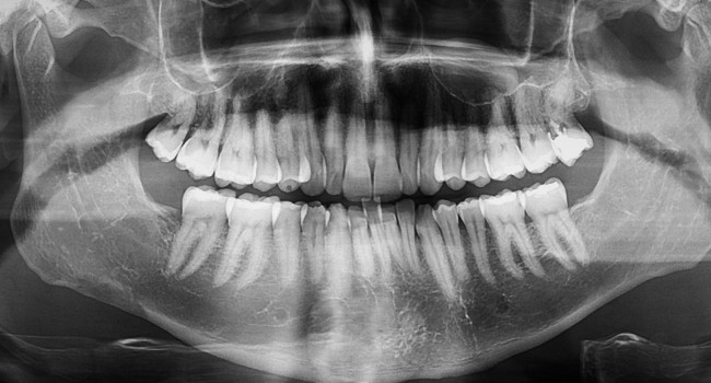 radiografie dentara panoramica