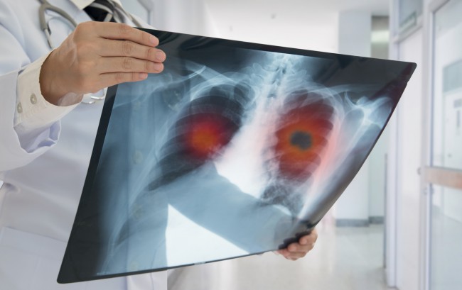 radiografie pulmonara pentru cancer de plamani