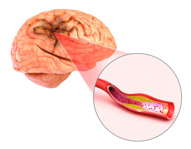 detaliu cu artera de la creier