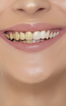 Demineralizarea dinţilor: ce este şi cum te afectează