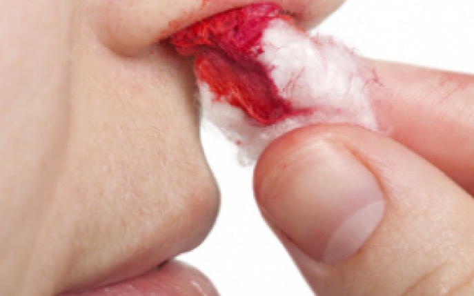 De ce curge sange din nas si cand e cazul sa te alarmezi