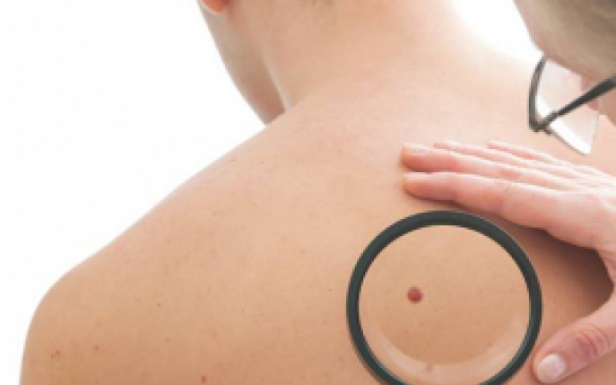 De ce sunt femeile mai afectate de epidemia de cancer de piele decat barbatii