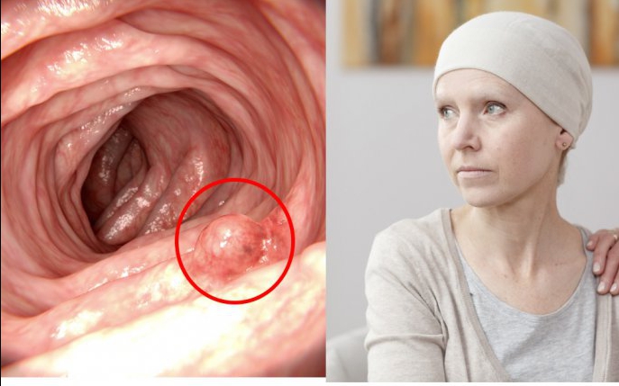 Greşeala pe care o faci zilnic şi care poate duce la cancer de colon
