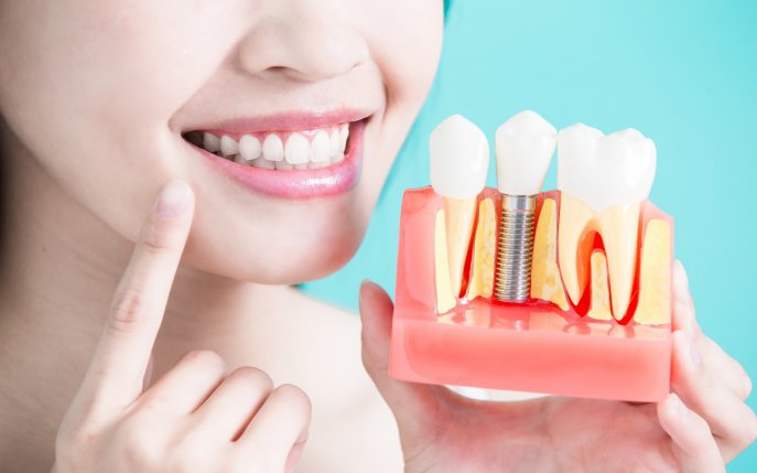 Tot ce trebuie să știi despre implantul dentar