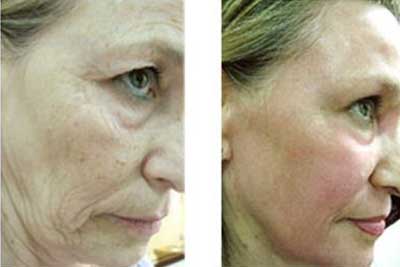 Tratamentul ridurilor cu Botox si Restylane