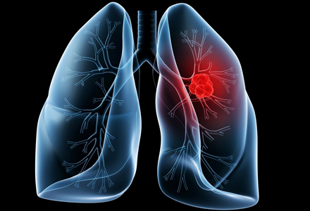 Cancer La Plamani Simptome Cancer La Plamani