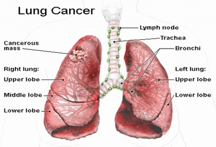 cancer pumonar