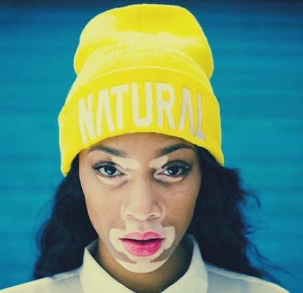 Boala Vitiligo