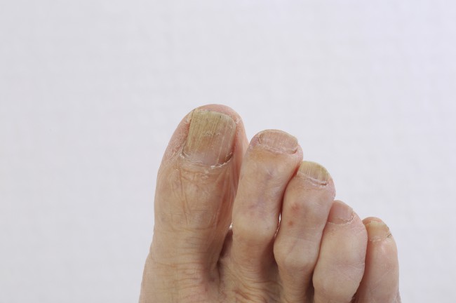 ciuperca ezoterică a unghiilor de la picioare ciuperca și tratamentul acesteia asupra unghiilor