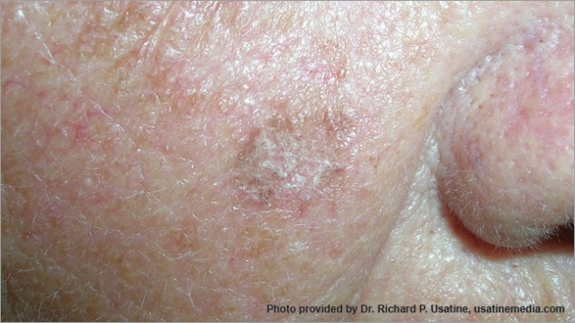 Semnele si simptomele cancerului de piele