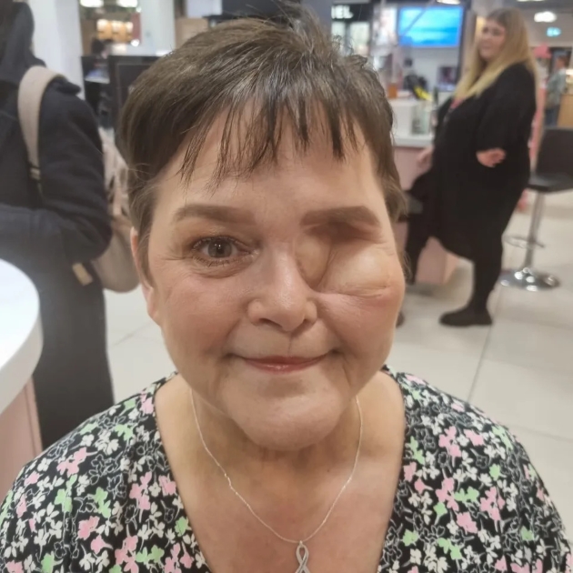 melanie wellings a ramas cu o gaura in fata in urma celor sase interventii chirurgicale prin care a trecut