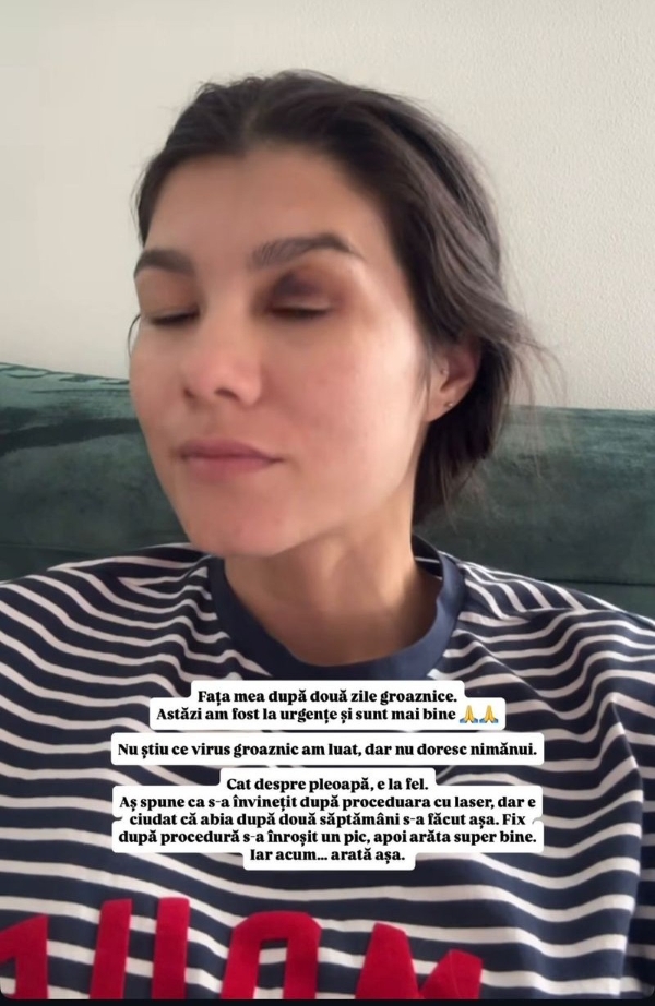 ileana sterp a postat pe instagram o poza in care apare cu ochiul vanat