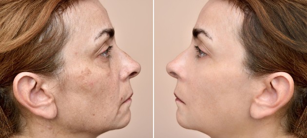Imagine cu un colaj cu două imagini: una cu o față de femeie cu pete acneice și alta cu o față de femeie cu tenul curat
