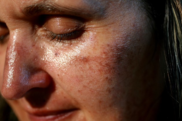 Imagine cu o femeie cu pete pigmentate pe față