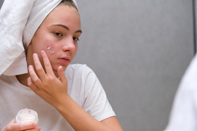 Imagine cu o fată care folosește tratament anti-acnee