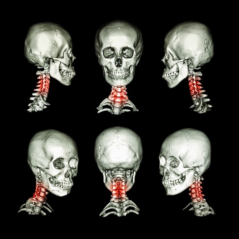 Radiografie coloana cervicala