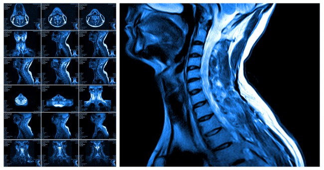 Radiografie coloana cervicală