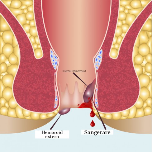 Infografic hemoroizi interni si externi