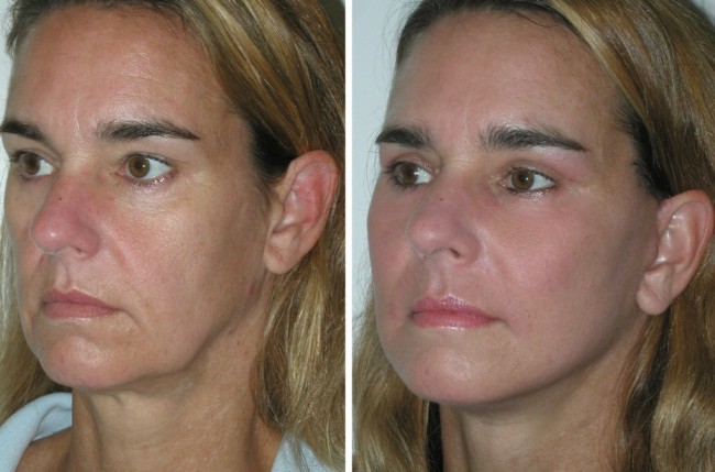 Lifting facial cu fire bio-resorbabile