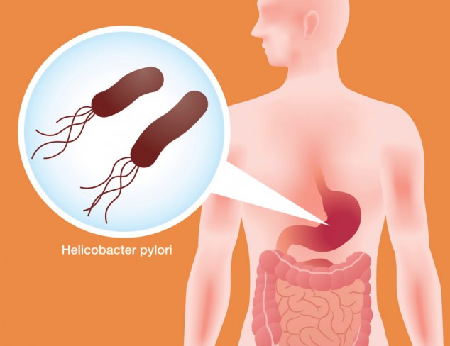 Stomac uman si helicobacter pylori