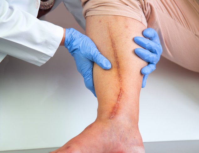 venele varicoase pe medicul picioarelor metoda oamenilor de tratament a tromboflebitei varicoza