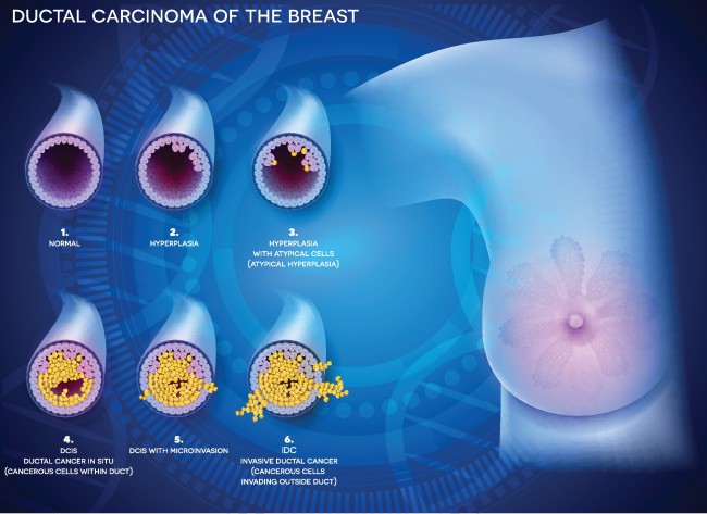 cancerul mamar invaziv