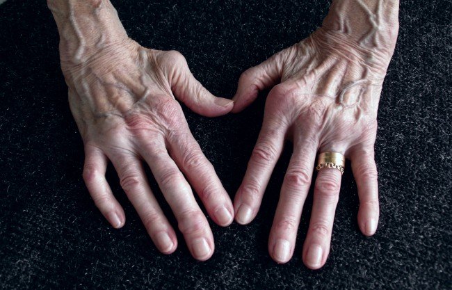 artrită mâini artrite
