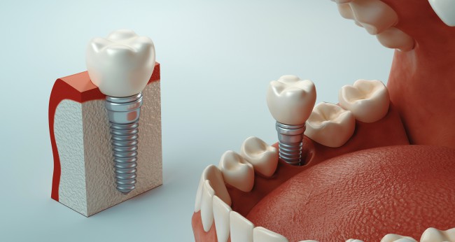 Implant dentar pentru parodontoza