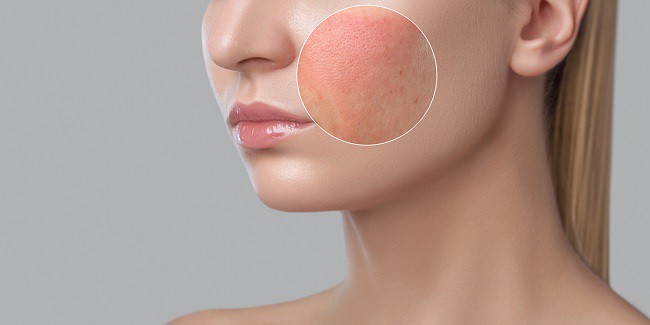 femeie frumoasa machata cu prim plan pe obraz a unei zone inflamate cu alergie si iritatiii