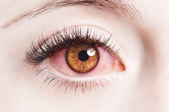 prim plan pe un ochi de femeie rosu din cauza alergiei