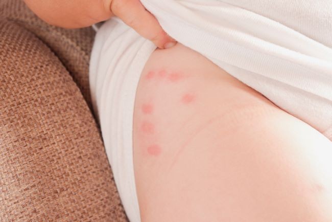 regiune de coapsa de femeie cu muscaturi de plosnita, vizibile din pantaloni scurti