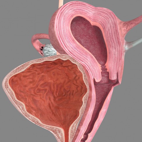 fibrom uterin