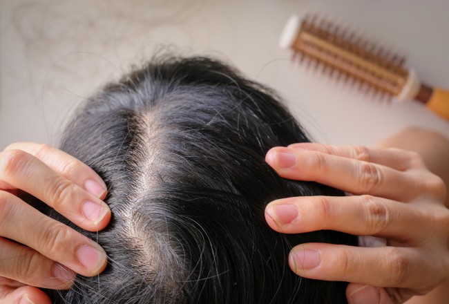 femeie care se confrunta cu alopecie areata