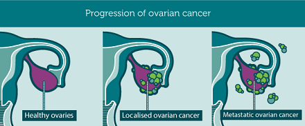 Progresul cancerului ovarian
