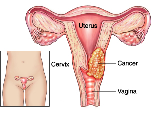 Cancer de col uterin