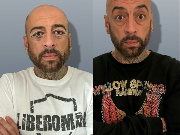colaj foto cu crbl inainte de interventia chirurgicala cu creion alb la ochi