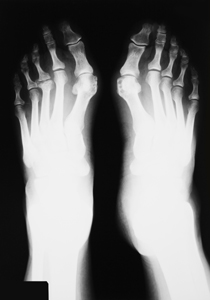 monturi radiografie hallux valgus