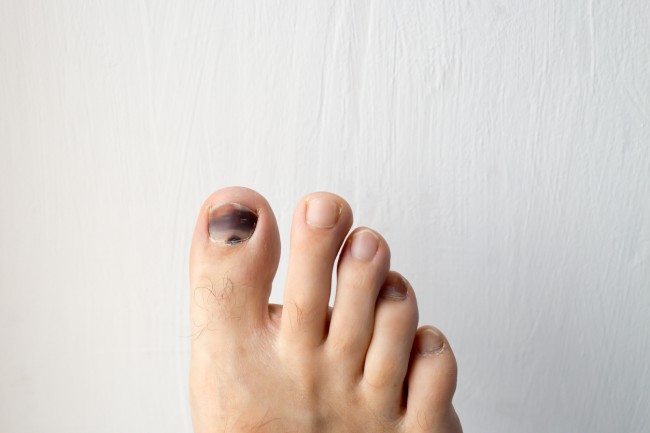 refacerea unghiilor de la picioare după ciupercă)