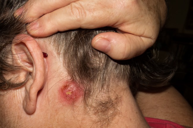 infectie cu stafilococ auriu dupa ureche