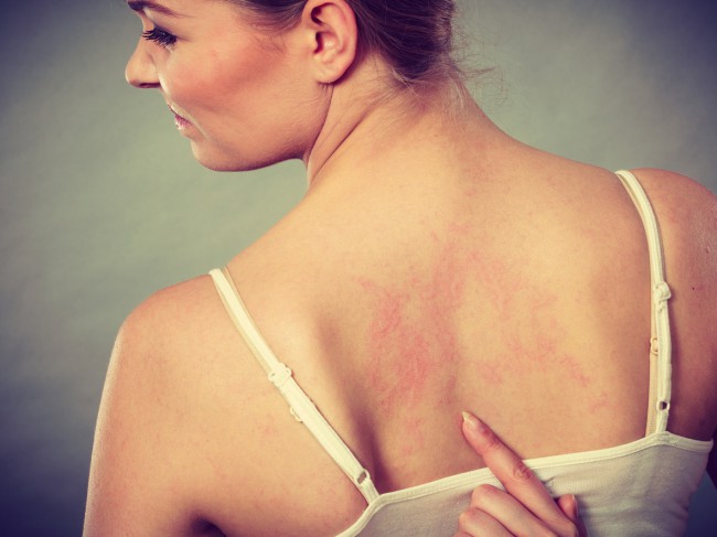 femeie cu iritatie pe spate