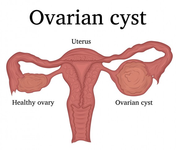 chist ovarian