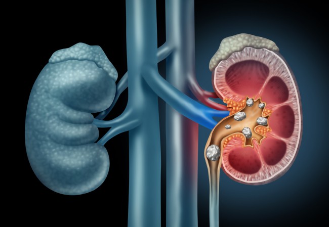 Sfatul Farmacistului: Dureri lombare sau de rinichi?