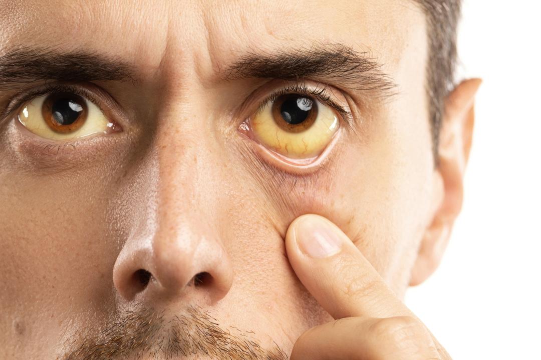 sindromul gilbert-bărbat cu ochi ingalbeniti
