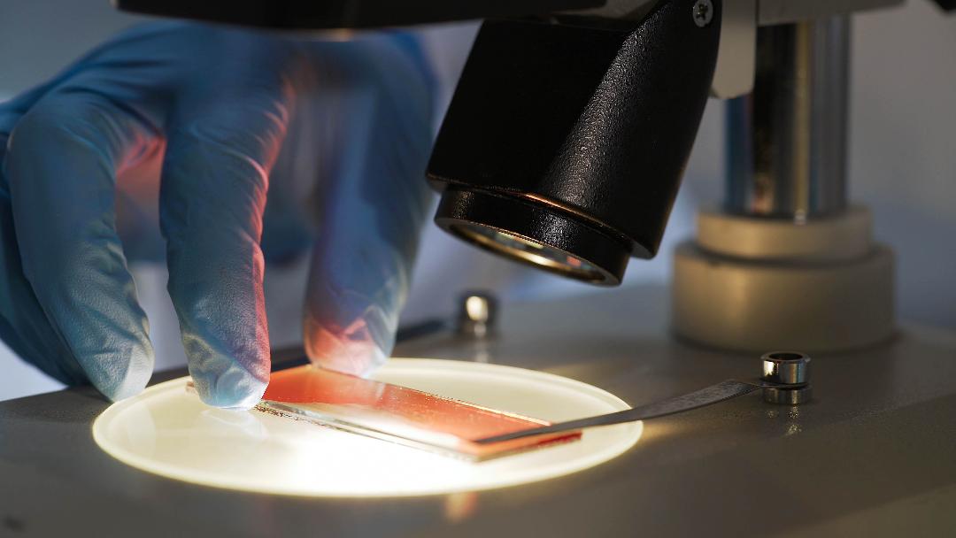 reticulocite mărite-sânge analizat pe lamelă de microscop