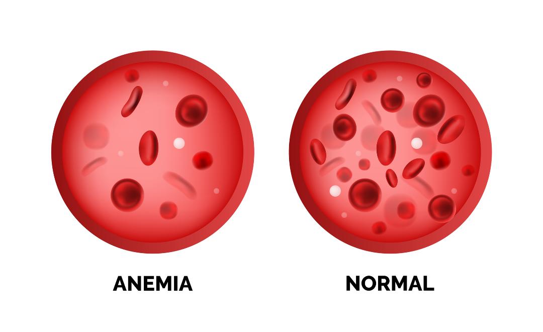 reticulocite mărite-sange anemic vs normal