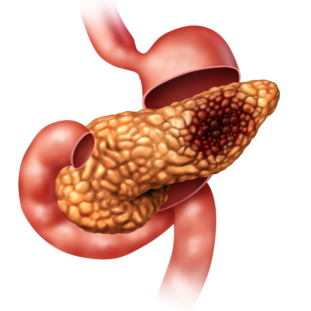 amilază serică-pancreas bolnav
