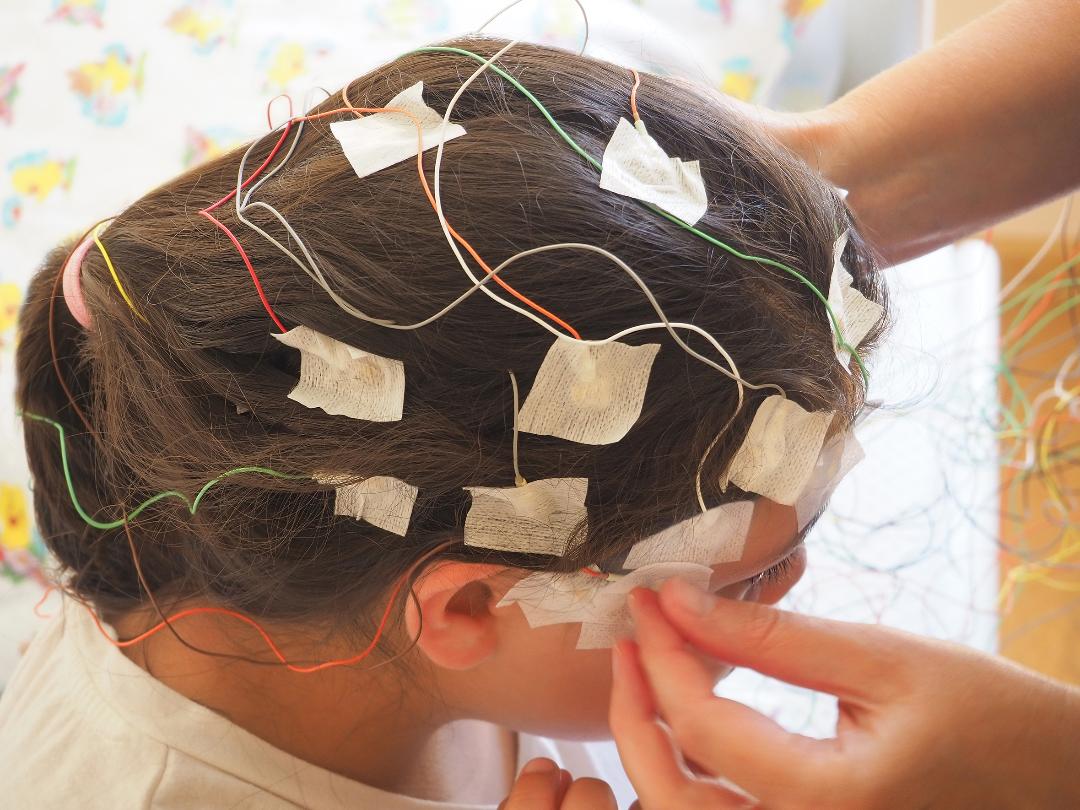 sindromul lennox-gastaut-fată cu electrozi pe cap