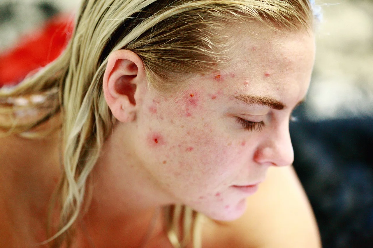 acneea la adulți-femeie cu acnee severă pe față