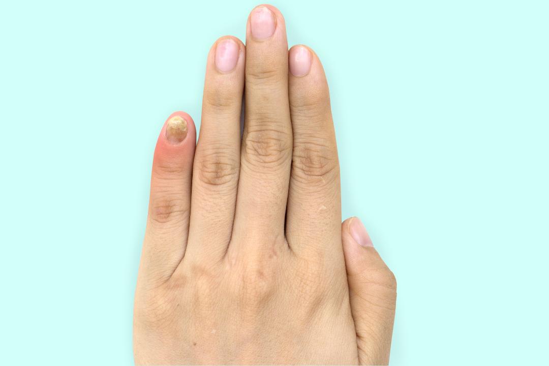 mucegai pe unghie- unghie infectată de la degetul mic